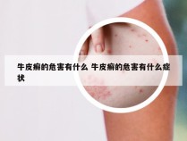 牛皮癣的危害有什么 牛皮癣的危害有什么症状