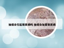 抽烟会引起银屑病吗 抽烟会加重银屑病