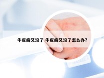 牛皮癣又没了 牛皮癣又没了怎么办?