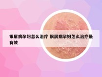银屑病孕妇怎么治疗 银屑病孕妇怎么治疗最有效