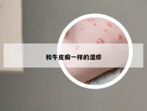 和牛皮癣一样的湿疹