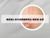 糖尿病人有牛皮癣骚痒咋办 糖尿病 皮癣