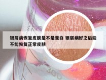 银屑病恢复皮肤是不是变白 银屑病好之后能不能恢复正常皮肤
