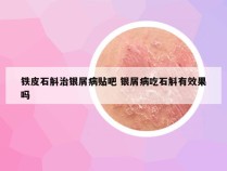 铁皮石斛治银屑病贴吧 银屑病吃石斛有效果吗
