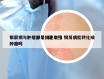 银屑病与肿瘤都是细胞增殖 银屑病能转化成肿瘤吗