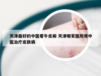 天津最好的中医看牛皮癣 天津哪家医院用中医治疗皮肤病