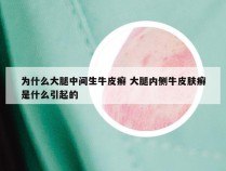 为什么大腿中间生牛皮癣 大腿内侧牛皮肤癣是什么引起的