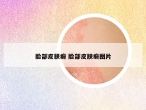 脸部皮肤癣 脸部皮肤癣图片