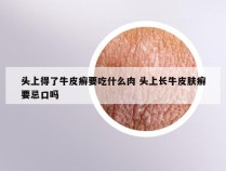 头上得了牛皮癣要吃什么肉 头上长牛皮肤癣要忌口吗