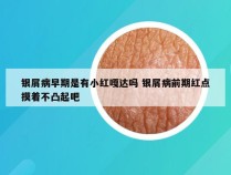 银屑病早期是有小红嘎达吗 银屑病前期红点摸着不凸起吧