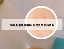 蚂蚁丸治牛皮癣吗 蚂蚁丸的中药名叫