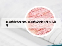 银屑病颜色变粉色 银屑病成粉色还要多久能好