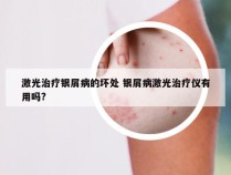 激光治疗银屑病的坏处 银屑病激光治疗仪有用吗?