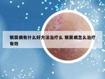 银屑病有什么好方法治疗么 银屑病怎么治疗有效