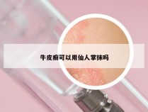 牛皮癣可以用仙人掌抹吗