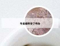 牛皮癣怀孕了咋办