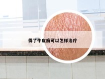 得了牛皮癣可以怎样治疗