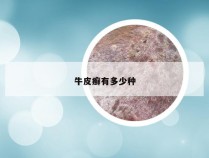牛皮癣有多少种