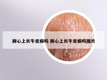 脚心上长牛皮癣吗 脚心上长牛皮癣吗图片