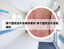 哪个医院治牛皮癣效果好 哪个医院治牛皮肤癣好