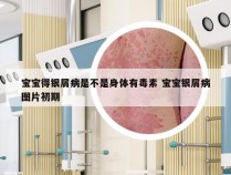 宝宝得银屑病是不是身体有毒素 宝宝银屑病图片初期
