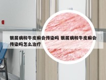 银屑病和牛皮癣会传染吗 银屑病和牛皮癣会传染吗怎么治疗