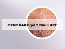牛皮癣中着不能打ppd 牛皮癣可不可以打