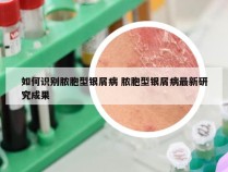 如何识别脓胞型银屑病 脓胞型银屑病最新研究成果