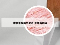 脾和牛皮癣的关系 牛脾癣病因