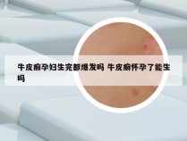 牛皮癣孕妇生完都爆发吗 牛皮癣怀孕了能生吗
