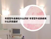 寻常型牛皮癣吃什么药好 寻常型牛皮肤癣用什么药膏最好