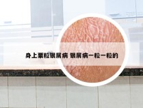 身上粟粒银屑病 银屑病一粒一粒的
