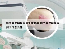得了牛皮癣找不到工作知乎 得了牛皮癣找不到工作怎么办