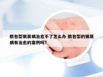 脓包型银屑病治愈不了怎么办 脓包型的银屑病有治愈的案例吗?