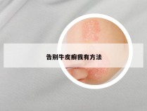 告别牛皮癣我有方法