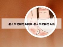 老人牛皮癣怎么回事 老人牛皮鲜怎么治