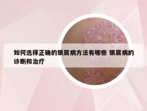 如何选择正确的银屑病方法有哪些 银屑病的诊断和治疗