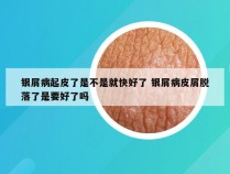 银屑病起皮了是不是就快好了 银屑病皮屑脱落了是要好了吗