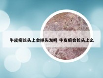 牛皮癣长头上会掉头发吗 牛皮癣会长头上么