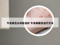 牛皮癣怎么样能治好 牛皮癣最快治疗方法
