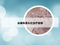 白癜风用火针治疗视频