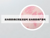 反向银屑病红斑能消退吗 反向银屑病严重吗