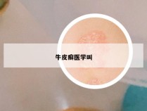 牛皮癣医学叫