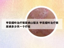 甲氨蝶呤治疗银屑病口服法 甲氨蝶呤治疗银屑病多少天一个疗程