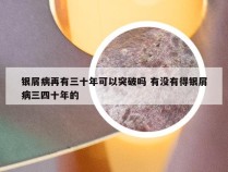 银屑病再有三十年可以突破吗 有没有得银屑病三四十年的