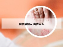 癣传染别人 癣传人么
