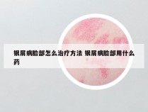 银屑病脸部怎么治疗方法 银屑病脸部用什么药