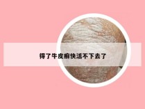 得了牛皮癣快活不下去了