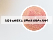 街边牛皮癣香蕉水 香蕉皮擦银屑病效果好吗