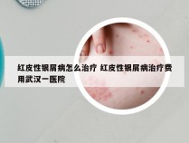红皮性银屑病怎么治疗 红皮性银屑病治疗费用武汉一医院